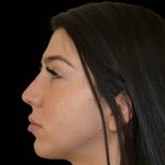 Rhinoplasty Before & After Patient #16488