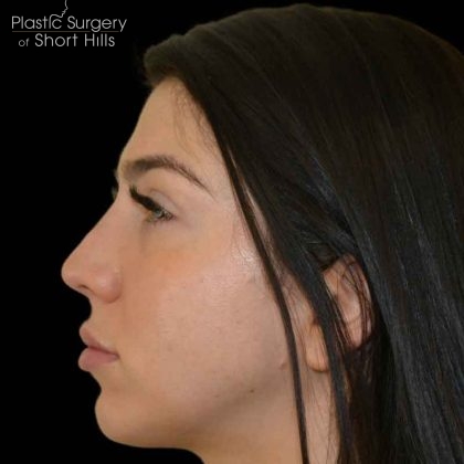 Rhinoplasty Before & After Patient #16488