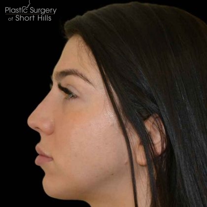 Lip Filler Before & After Patient #16488