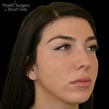 Lip Filler Before & After Patient #16488