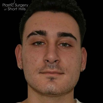 Rhinoplasty Before & After Patient #16489