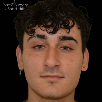 Rhinoplasty Before & After Patient #16489