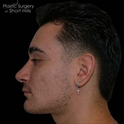 Rhinoplasty Before & After Patient #16489