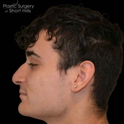 Rhinoplasty Before & After Patient #16489