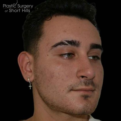 Rhinoplasty Before & After Patient #16489