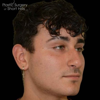 Rhinoplasty Before & After Patient #16489