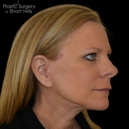 Facelift Before & After Patient #16364