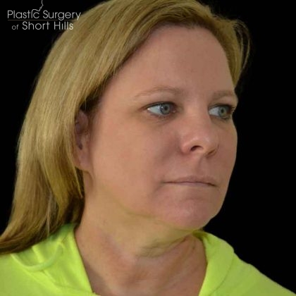 Facelift Before & After Patient #16364