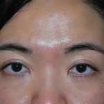 Blepharoplasty Before & After Patient #16407