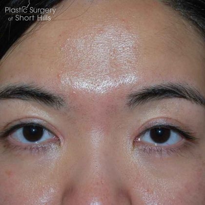 Blepharoplasty Before & After Patient #16407