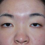 Blepharoplasty Before & After Patient #16407