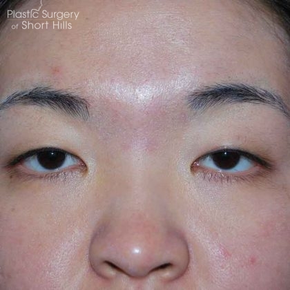 Blepharoplasty Before & After Patient #16407