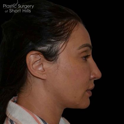 Liposuction-Face Before & After Patient #16416