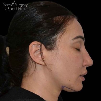 Liposuction-Face Before & After Patient #16416