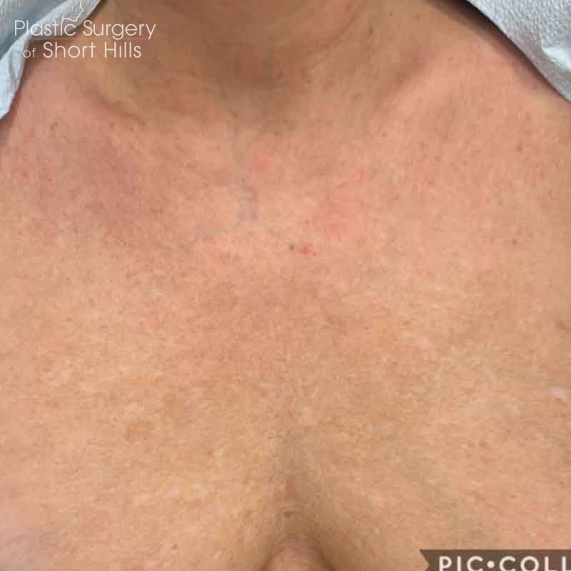 IPL / ResurFX Before & After Patient #16411