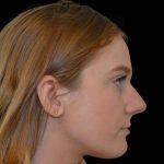 Rhinoplasty Before & After Patient #16490