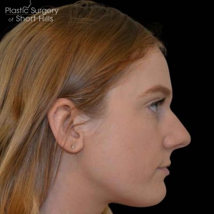 Rhinoplasty Before & After Patient #16490