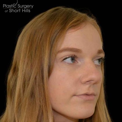 Rhinoplasty Before & After Patient #16490