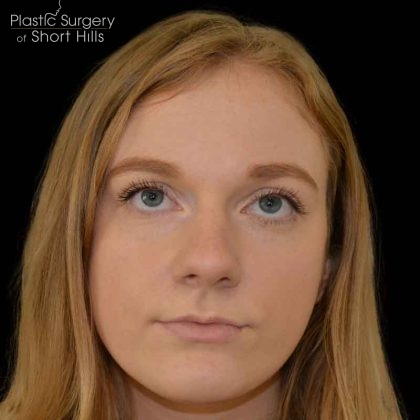 Rhinoplasty Before & After Patient #16490