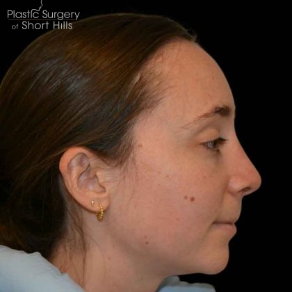 Rhinoplasty Before & After Patient #16491