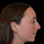 Rhinoplasty Before & After Patient #16491