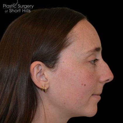 Rhinoplasty Before & After Patient #16491