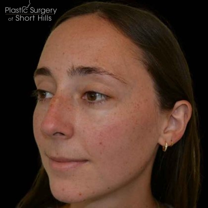 Rhinoplasty Before & After Patient #16491