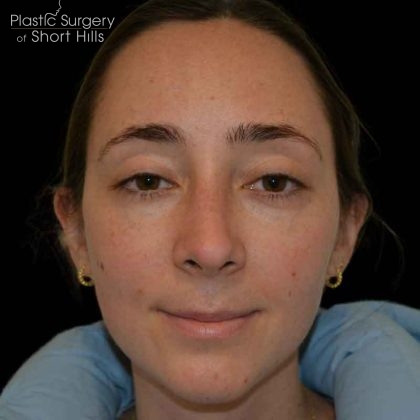 Rhinoplasty Before & After Patient #16491