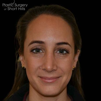 Rhinoplasty Before & After Patient #16492