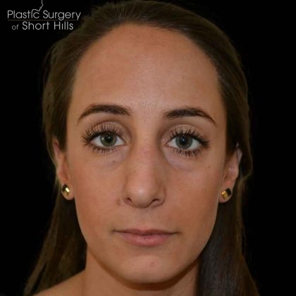 Rhinoplasty Before & After Patient #16492