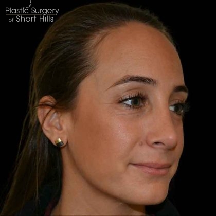 Rhinoplasty Before & After Patient #16492