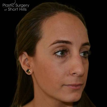 Rhinoplasty Before & After Patient #16492