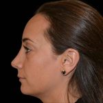Rhinoplasty Before & After Patient #16492