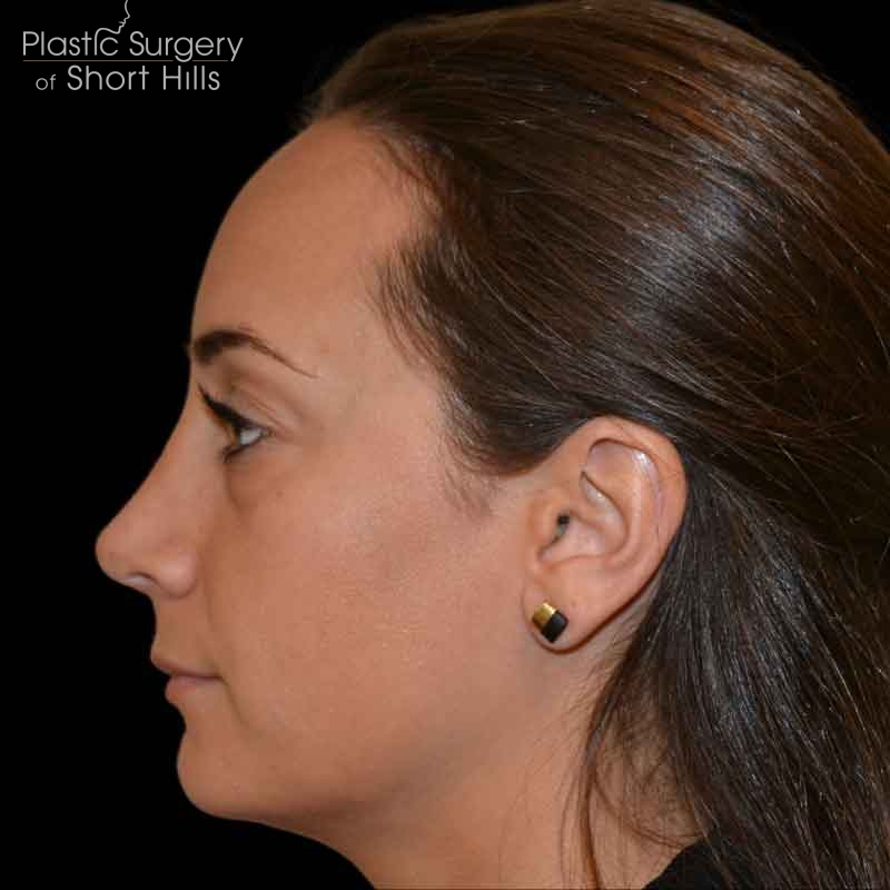 Rhinoplasty Before & After Patient #16492