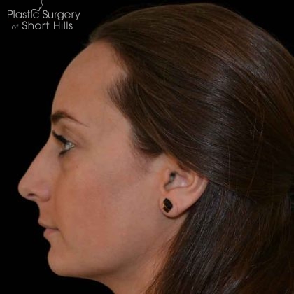 Rhinoplasty Before & After Patient #16492