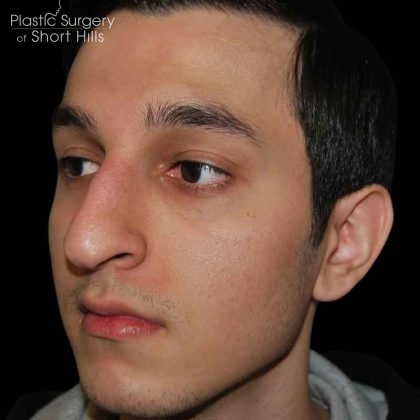Rhinoplasty Before & After Patient #16494
