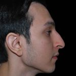 Rhinoplasty Before & After Patient #16494