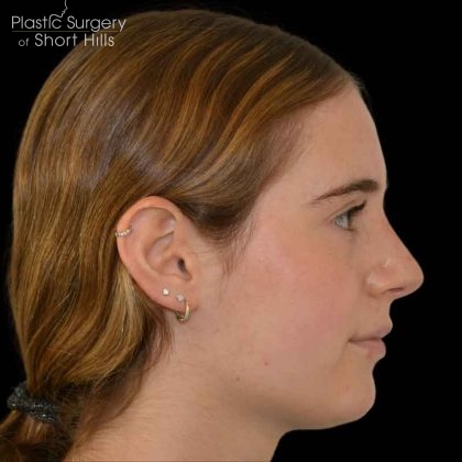 Rhinoplasty Before & After Patient #16577