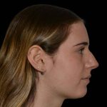 Rhinoplasty Before & After Patient #16577