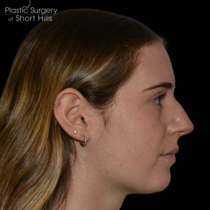 Rhinoplasty Before & After Patient #16577
