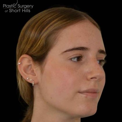 Rhinoplasty Before & After Patient #16577