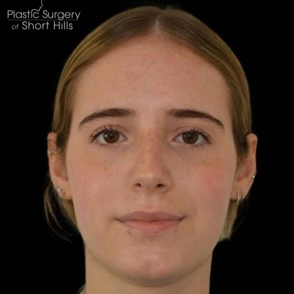 Rhinoplasty Before & After Patient #16577