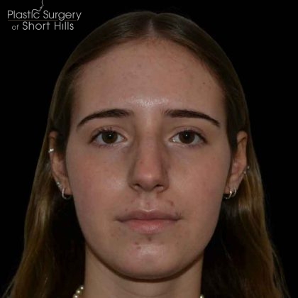 Rhinoplasty Before & After Patient #16577