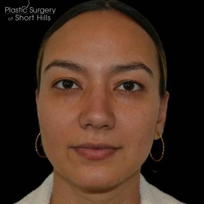 Rhinoplasty Before & After Patient #16578