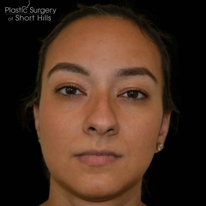 Rhinoplasty Before & After Patient #16578