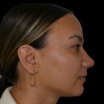 Rhinoplasty Before & After Patient #16578