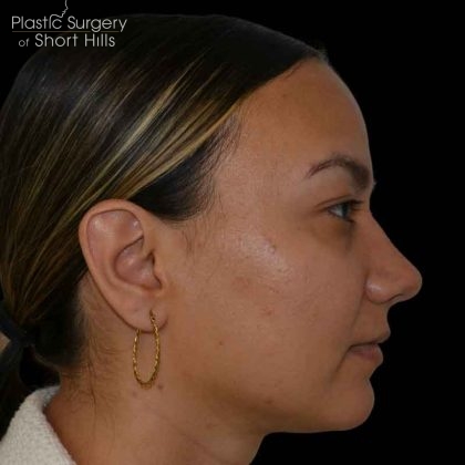 Rhinoplasty Before & After Patient #16578