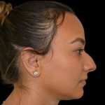 Rhinoplasty Before & After Patient #16578