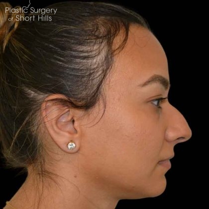 Rhinoplasty Before & After Patient #16578