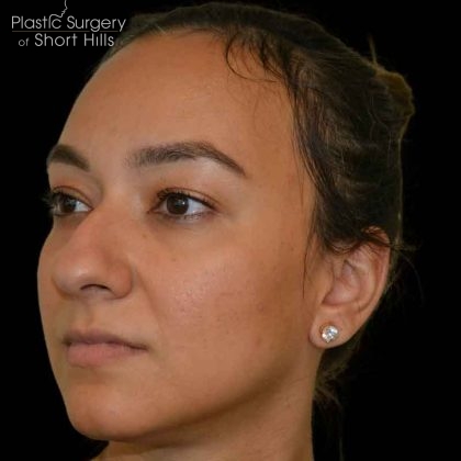 Rhinoplasty Before & After Patient #16578